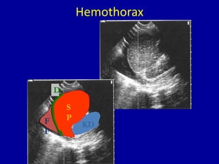 Hemothorax
KD
S
PF
F
D
 