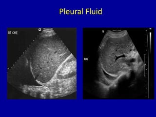 Pleural Fluid
 