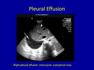 Pleural Effusion
Right pleural effusion, transverse subxiphoid view
 
