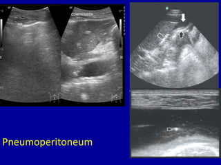 Pneumoperitoneum
 