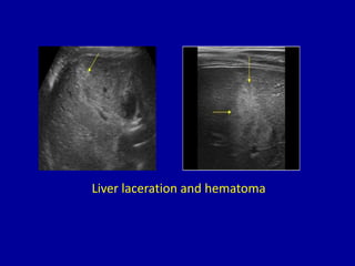Liver laceration and hematoma
 