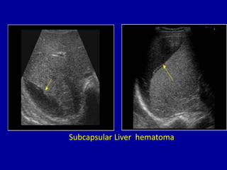Subcapsular Liver hematoma
 