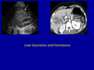 Liver laceration and hematoma
 