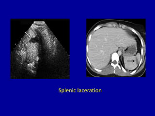 Splenic laceration
 