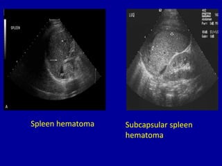 Spleen hematoma Subcapsular spleen
hematoma
 