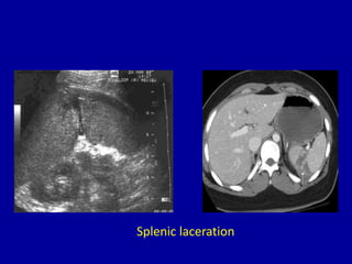 Splenic laceration
 