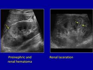 Preinephric and
renal hematoma
Renal laceration
 