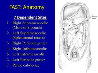 FAST: Anatomy
7 Dependent Sites
1. Right Supramesocolic
(Morison’s pouch)
2. Left Supramesocolic
(Splenorenal recess)
3. Right Pericolic gutter
4. Right Inframesocolic
5. Left Inframesocolic
6. Left Pericolic gutter
7. Pelvic cul-de-sac
 