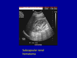 Subcapsular renal
hematoma
 