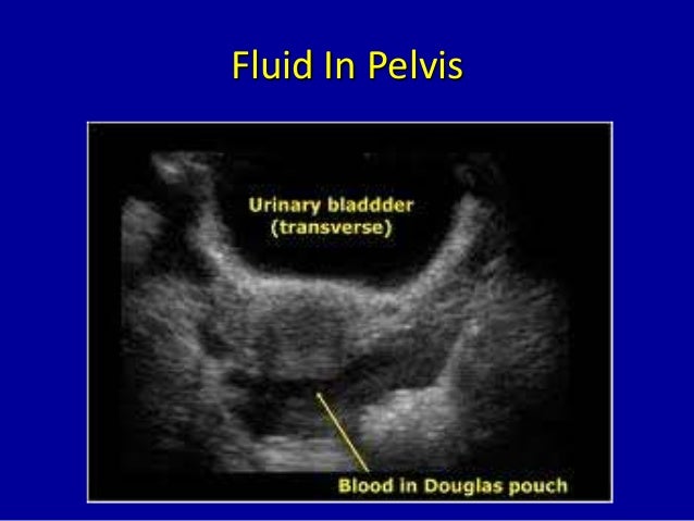 Pouch Douglas Free Fluid In Pod A Probe position for Morison #39 s pouch Pouch Douglas Free Fluid In Pod A Probe position for Morison #39 s pouch