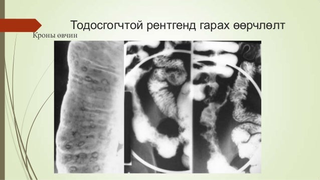 Шархлаат колит & Кроны өвчин