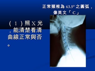 正常頸椎為正常頸椎為 63.5°63.5° 之圓弧，之圓弧，
像英文「像英文「 CC 」」
（（ 11 ）照）照 XX 光光
，能清楚看清，能清楚看清
曲線正常與否曲線正常與否
。。
 