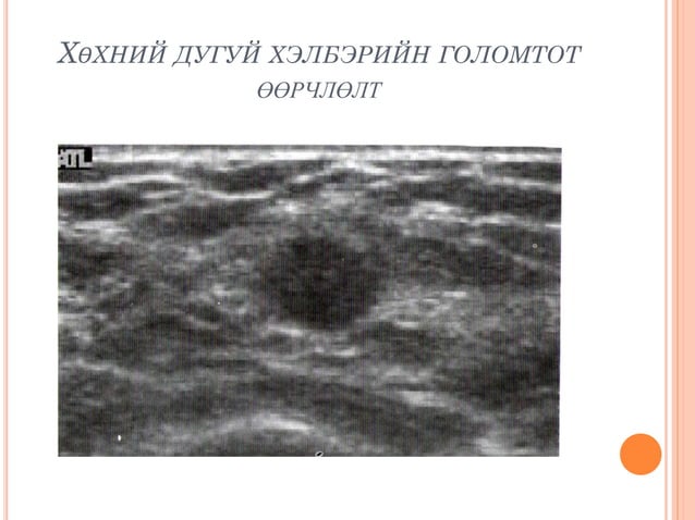 хөхний хэт авиан оношлогоо