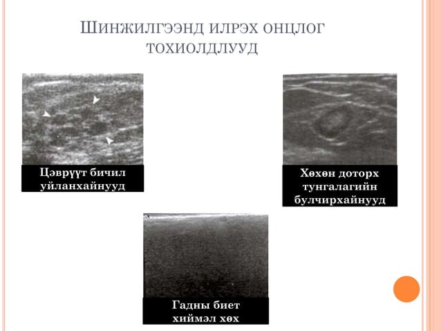 хөхний хэт авиан оношлогоо