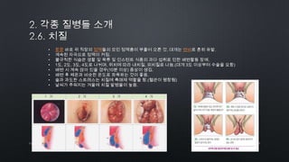21by 토니토닉
• 항문 바로 위 직장의 정맥들의 모인 정맥총이 부풀어 오른 것. 대개는 변비로 흔히 유발.
• 계속된 자극으로 정맥이 커짐.
• 불규칙한 식습관 생활 및 육류 및 인스턴트 식품의 과다 섭취로 인한 배변활동 장애.
• 1도, 2도, 3도, 4도로 나뉘며, 위치에 따라 내치질, 외치질로 나눔.(대개 3도 이상부터 수술을 요함)
• 배변 시 계속 앉아 있을 경우(10분 이상) 증상이 생김.
• 배변 후 체온과 비슷한 온도로 좌욕하는 것이 좋음.
• 술과 과도한 스트레스는 치질에 촉매제 역할을 함.(혈관이 팽창됨)
• 날씨가 추워지는 겨울에 치질 발병율이 높음.
 