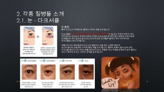 6by 토니토닉
◎ 원인
혈액 내 산소가 부족할 때, 혈액이 어두운 색을 띠게 됩니다
다크서클은 수면부족, 피로축적, 스트레스 등의 원인으로 눈 밑 또는 주위의 피부의 색이
어두워지는 것으로 눈 주위의 피부는 두께가 0.6mm정도로 매우 얇기 때문에 피부아래에
모세혈관의 색이 겉으로 잘 드러나 보이게 되며, 모세혈과 혈액의 색이 어두워지면
다크서클로 나타나게 됩니다.
적혈구에 있는 헤모글로빈이 산소와 결합되어 있을 때는 선명한 붉은색,
상소와 떨어져 있을 떄는 어두운 붉은 색을 띠게 됩니다. 혈액의 흐름이 좋지 않게 되면,
다크서클 뿐만아니라 피부노화를 촉진하게 되고, 원활한 대사 작용을 방해하여 쉽게 멜라닌
색소가 침착하게 되고, 피부는 탄력을 잃게 됩니다.
 