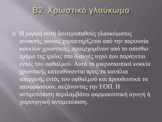  Ζ κνξθή απηή δεπηεξνπαζνύο γιαπθώκαηνο
αλνηθηήο γσλίαο ραξαθηεξίδεηαη από ηελ παξνπζία
θνθθίσλ ρξσζηηθήο, πξνεξρνκέλσλ από ην νπίζζην
ηκήκα ηεο ίξηδαο ζην δηαπγέο πγξό πνπ παξάγεηαη
εληόο ηνπ νθζαικνύ. Απηά ηα κηθξνζθνπηθά θνθθία
ρξσζηηθήο θαηεπζύλνληαη πξνο ηα θαλάιηα
απνξξνήο εληόο ηνπ νθζαικνύ θαη πξννδεπηηθά ηα
απνθξάζζνπλ, απμάλνληαο ηελ ΔΟΠ. Ζ
αληηκεηώπηζε πεξηιακβάλεη θαξκαθεπηηθή αγσγή ή
ρεηξνπξγηθή αληηκεηώπηζε.
 