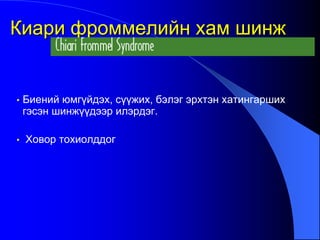 • Биений юмгүйдэх, сүүжих, бэлэг эрхтэн хатингарших
гэсэн шинжүүдээр илэрдэг.
• Ховор тохиолддог
Киари фроммелийн хам шинж
 