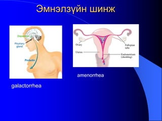 • galactorrhea
amenorrhea
Эмнэлзүйн шинж
 