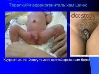 Хуурамч манин -Хэлүү томорч эрэгтэй эрхтэн шиг болох
Төрөлхийн адреногениталь хам шинж
 