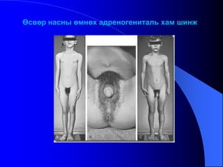 Өсвөр насны өмнөх адреногениталь хам шинж
 