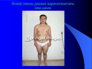Өсвөр насны дараах адреногениталь
хам шинж
 