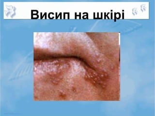 Висип на шкірі
 