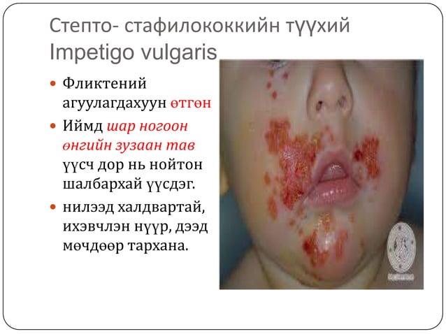 арьсны идээт өвчнүүд | PPT