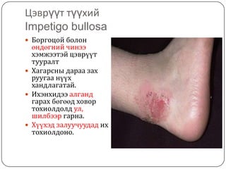 арьсны идээт өвчнүүд | PPT
