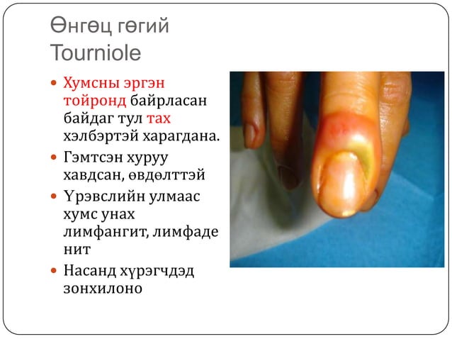 арьсны идээт өвчнүүд | PPT