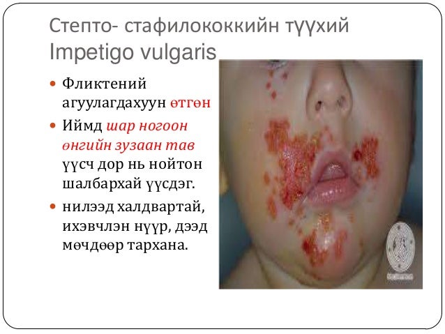 арьсны идээт өвчнүүд