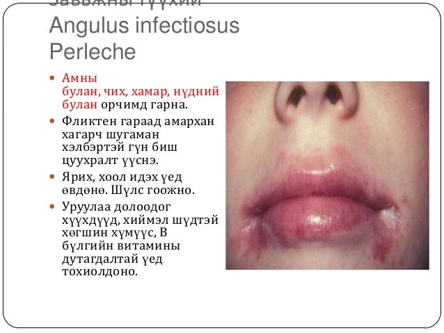 арьсны идээт өвчнүүд
