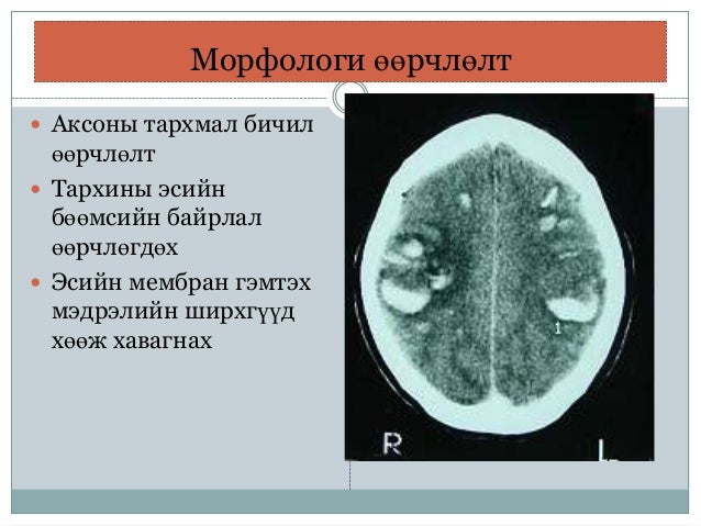 гавал тархины гэмтэл