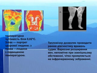 температурна
чутливість біля 0,02°С.
Зліва — портрет
здорової людини; з
права —людини
з підвищеною
температурою.
Тепловізор дозволяє проводити
ранню діагностику вражень
судин. Варкозне розширення
вен, непомітне при зовнішньому
обстеженні, чітко проявляється
на інфрачервоному зображенні.
 