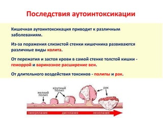 Последствия аутоинтоксикации
Кишечная аутоинтоксикация приводит к различным
заболеваниям.
Из-за поражения слизистой стенки кишечника развиваются
различные виды колита.
От пережатия и застоя крови в самой стенке толстой кишки -
геморрой и варикозное расширение вен.
От длительного воздействия токсинов - полипы и рак.
 