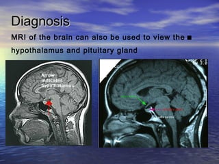 DiagnosisDiagnosis
.MRI of the brain can also be used to view the
hypothalamus and pituitary gland
 