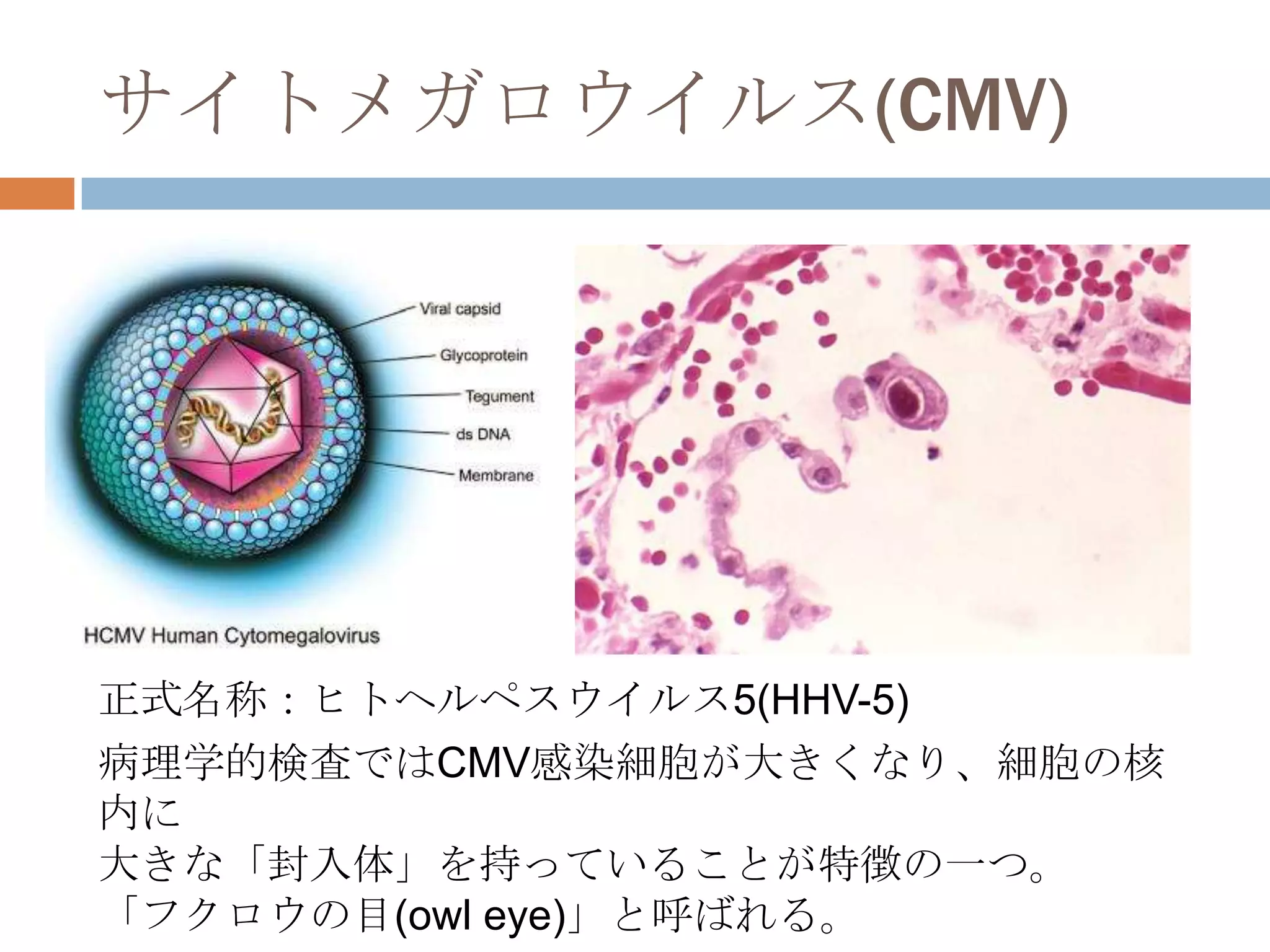 サイトメガロウイルス(CMV)
正式名称：ヒトヘルペスウイルス5(HHV-5)
病理学的検査ではCMV感染細胞が大きくなり、細胞の核
内に
大きな「封入体」を持っていることが特徴の一つ。
「フクロウの目(owl eye)」と呼ばれる。
 