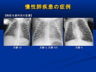 慢性肺疾患 もうだいぶ古いです
