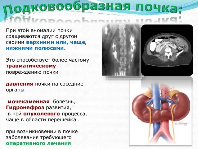 Аномалии мочевыводящих путей. Аномалии мочевыводящих путей