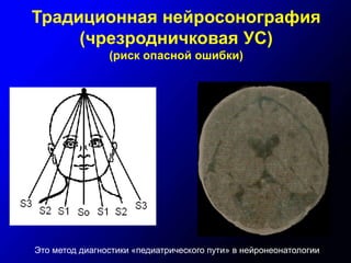 Традиционная нейросонография
(чрезродничковая УС)
(риск опасной ошибки)
Это метод диагностики «педиатрического пути» в нейронеонатологии
 