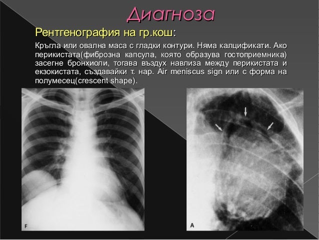 белодробен ехинокок