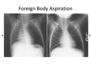 Foreign Body Aspiration
 