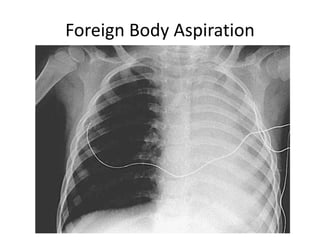 Foreign Body Aspiration
 