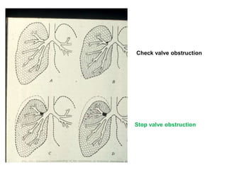 Check valve obstruction
Stop valve obstruction
 
