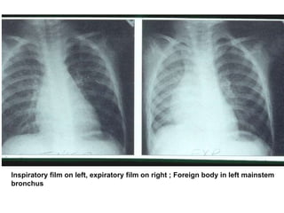 Inspiratory film on left, expiratory film on right ; Foreign body in left mainstem
bronchus
 