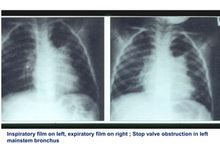 Inspiratory film on left, expiratory film on right ; Stop valve obstruction in left
mainstem bronchus
 