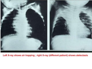 Left X-ray shows air trapping ; right X-ray (different patient) shows atelectasis
 