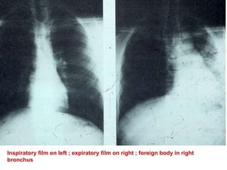 Inspiratory film on left ; expiratory film on right ; foreign body in right
bronchus
 