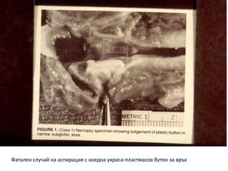 Fatal aspiration of an old Christmas bow button
Фатален случай на аспирация с коедна украса-пластмасов бутон за връх
 