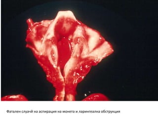Fatal laryngeal obstruction from a coin
Фатален слуачй на аспирация на монета и ларингеална обструкция
 